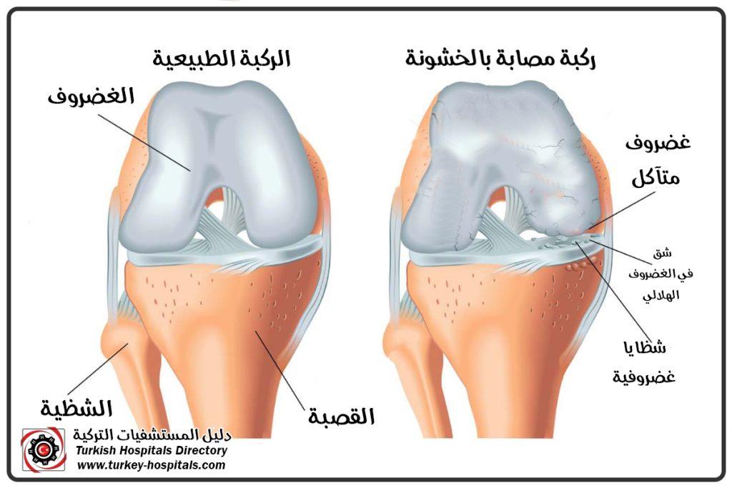 الأعراض التي لا يجب تجاهلها لفحص خشونة الركبة مبكراً