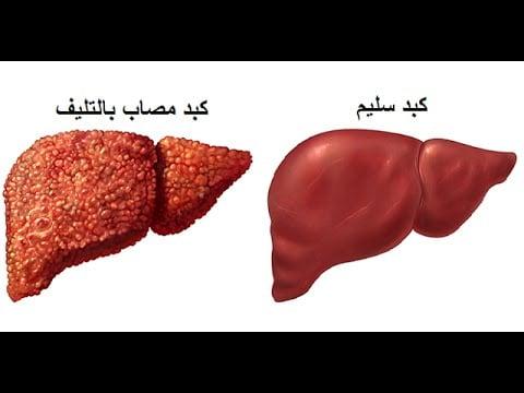 نصائح طبية للحفاظ على صحة الكبد وتقليل مضاعفاته