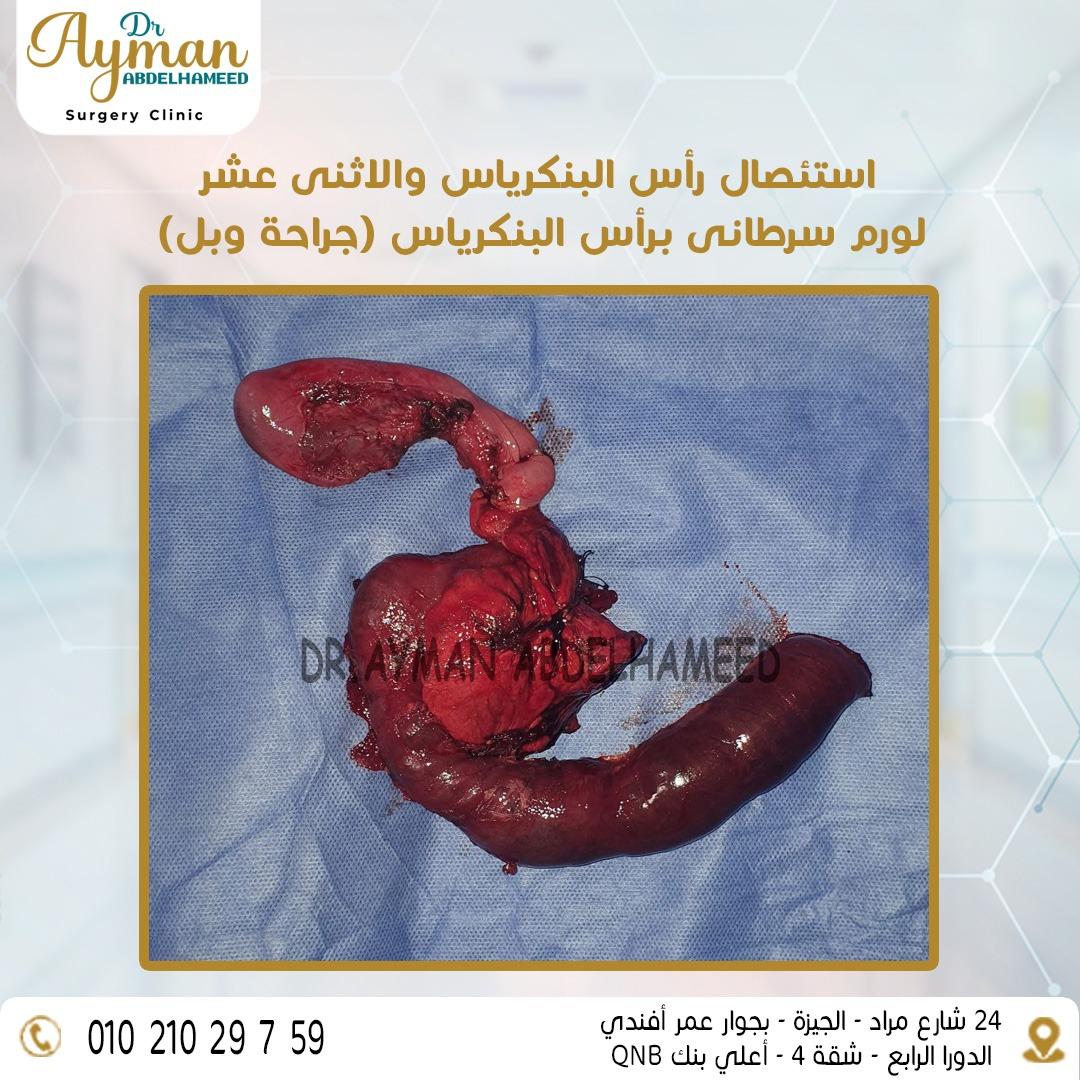 التفاصيل الطبية للعملية وتحديات ما بعد الجراحة