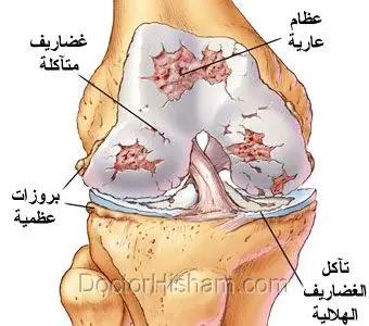 علامات مبكرة تصدرها ركبتك تدل على بداية خشونة المفصل