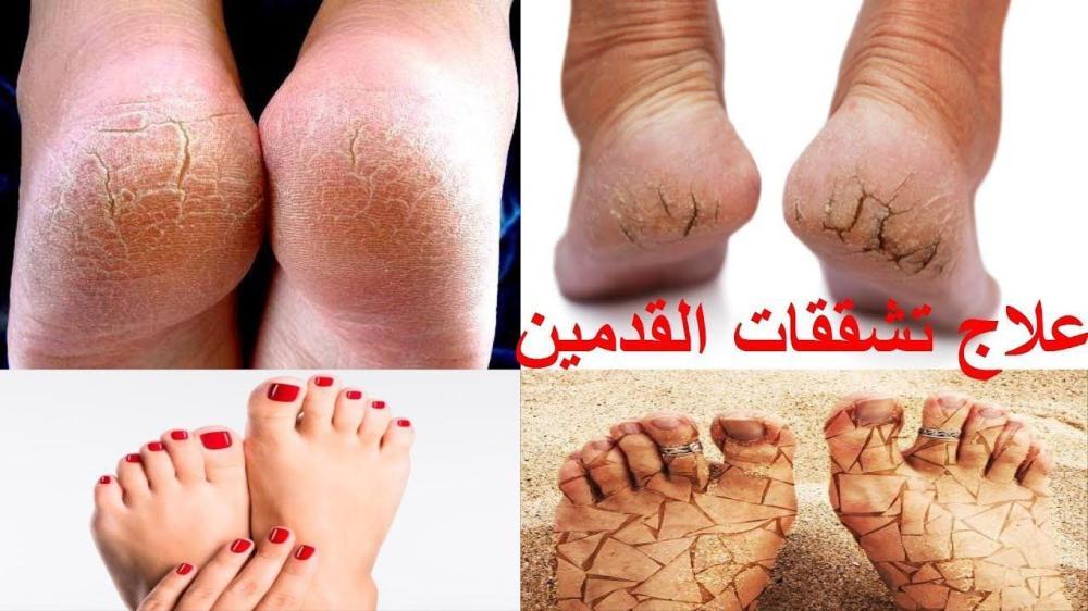 أفضل الطرق الطبيعية لعلاج خشونة الكعبين بمواد متوفرة في المنزل