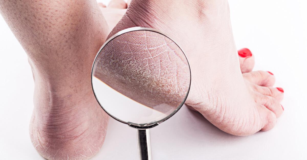 كيف تتعرف على أسباب خشونة الكعبين وطرق الوقاية منها