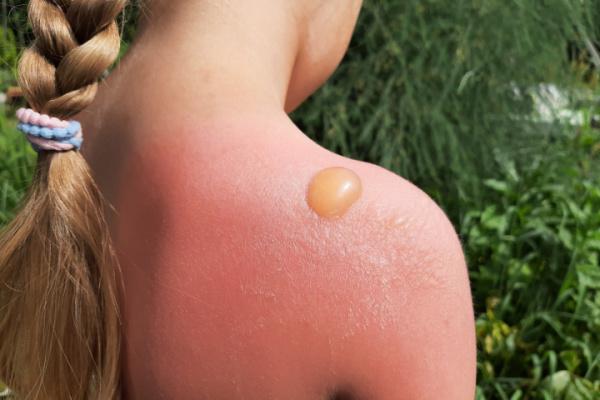أفضل المكونات الطبيعية لعلاج حروق الشمس بسرعة في المنزل