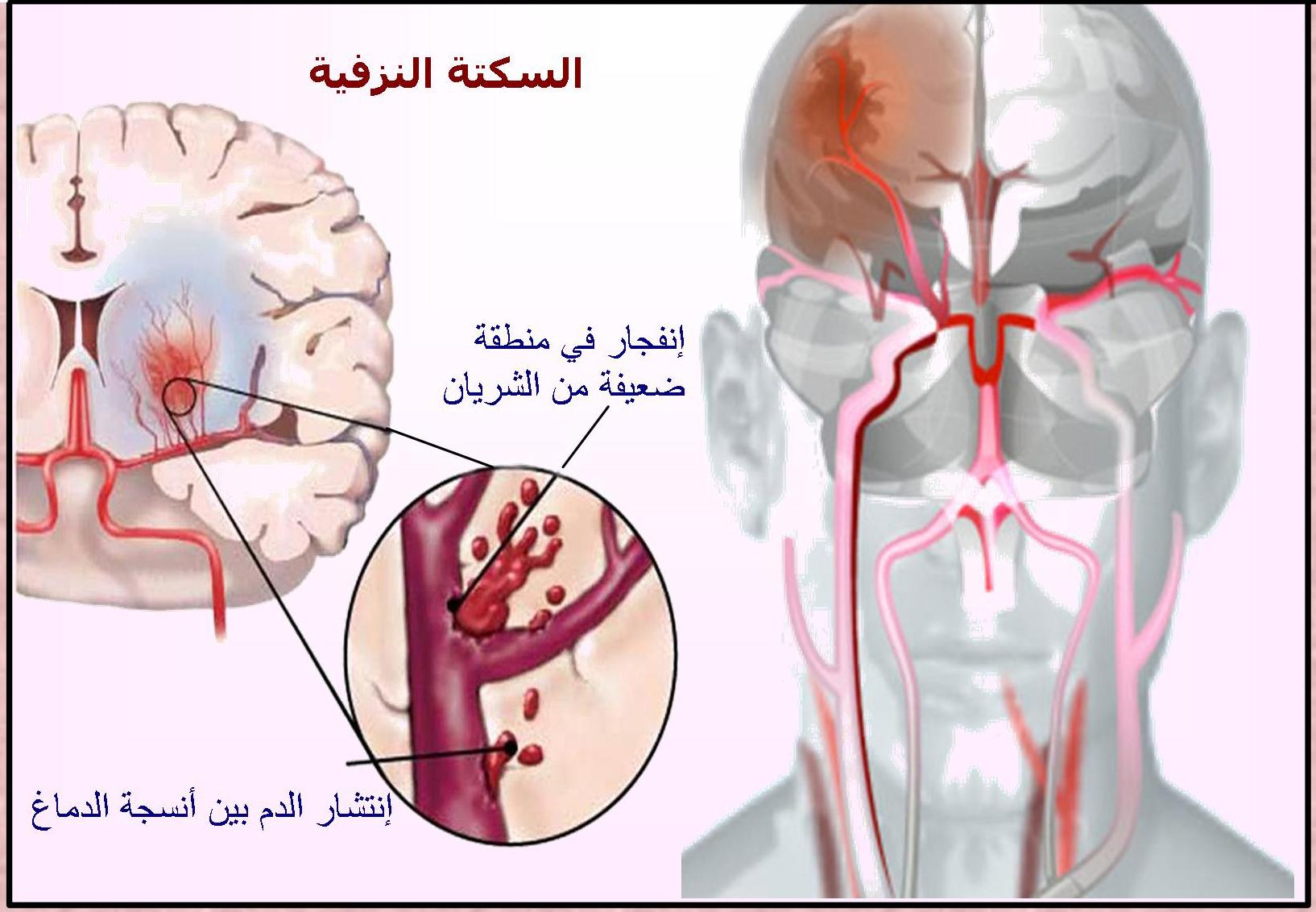نصائح للوقاية من الجلطات وتعزيز صحة الدماغ بطرق طبيعية وآمنة