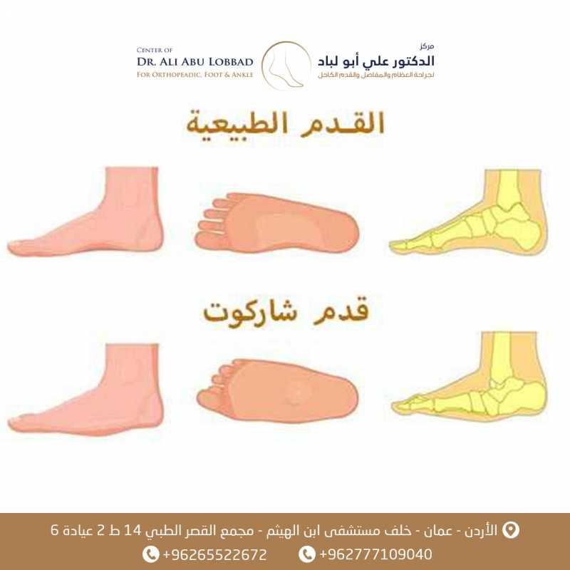 متى يجب استشارة الطبيب عند ملاحظة أعراض القدم غير الطبيعية