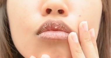 الأخطاء الشائعة التي تزيد من جفاف وتشقق الشفايف وكيف تتجنبها