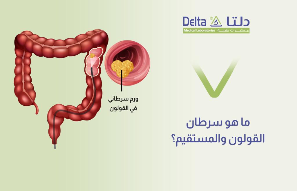 بدائل صحية لتحسين وقاية القولون من السرطان
