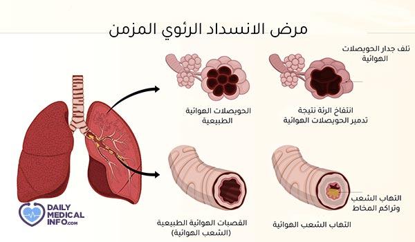 كيف تؤثر مضاعفات الانسداد الرئوي على جودة الحياة اليومية