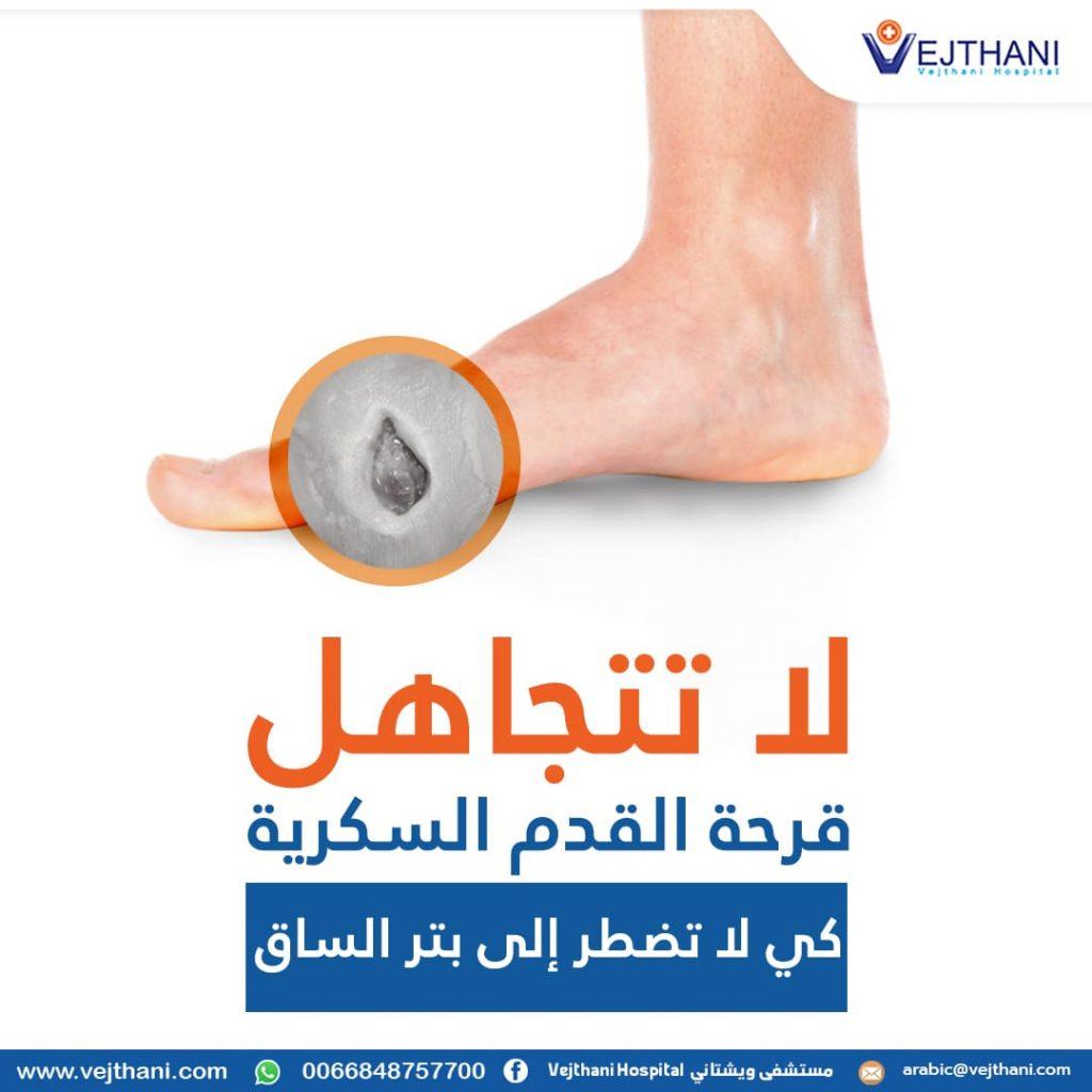 كيفية التعامل مع المضاعفات وتقليل مخاطر الغرغرينا والبتر