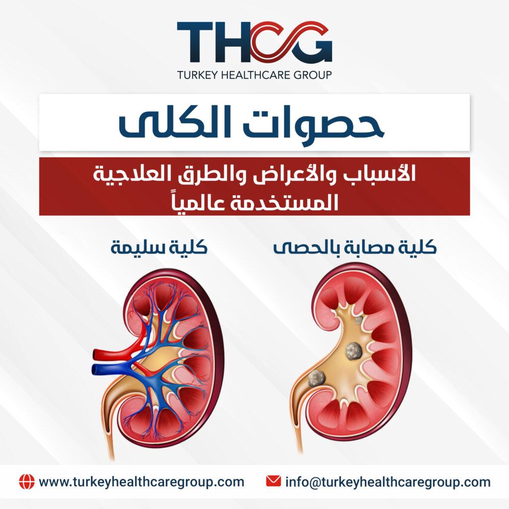 نصائح يومية لدعم وظائف الكلى وتقليل خطر الإصابة بحصوات الكلى