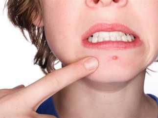 الممارسات التي يجب تجنبها للحفاظ على بشرة صحية وخالية من حب الشباب