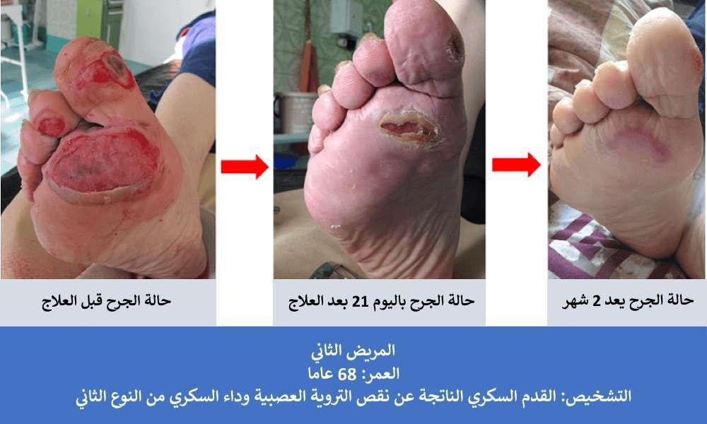 إجراءات الوقاية اليومية للحفاظ على صحة القدم السكري