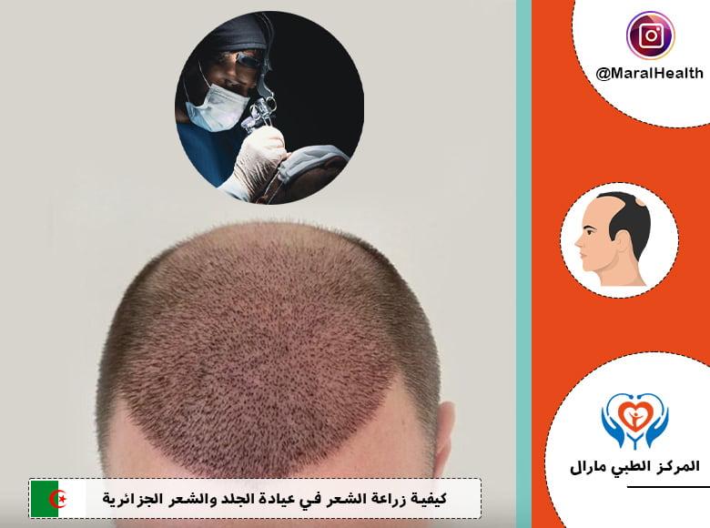 نصائح للحفاظ على صحة الشعر أثناء العمليات التجميلية
