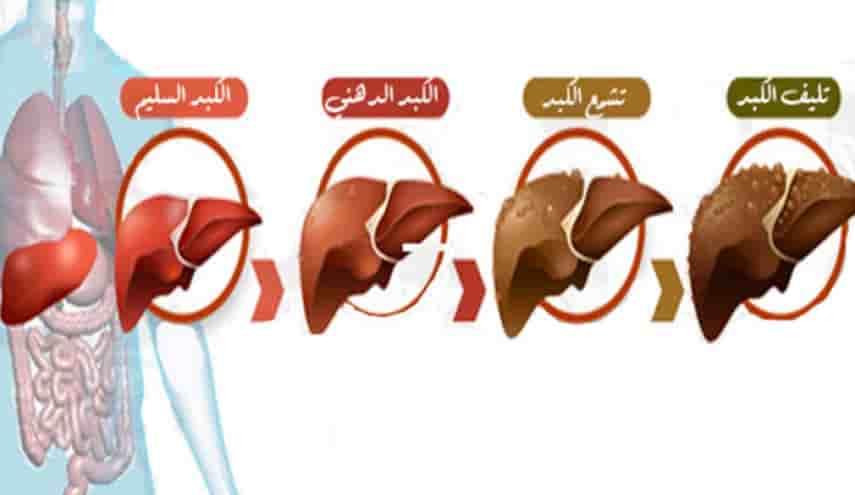 كيفية التعرف على الأعراض المبكرة لتلف الكبد