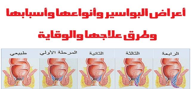 أهمية فهم أسباب البواسير لتجنب الآلام والمضاعفات