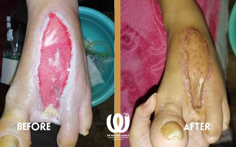 أسباب قرح القدم السكري وتأثيرها على صحة المريض