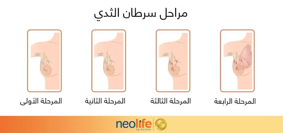 أعراض مبكرة في الثدي تستوجب الانتباه الفوري