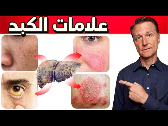 الأعراض المبكرة التي يجب الانتباه لها لتشخيص الكبد الدهني