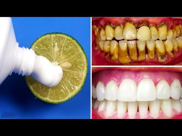 الأخطاء التي يجب تجنبها عند استخدام خلطات تبييض الأسنان الطبيعية