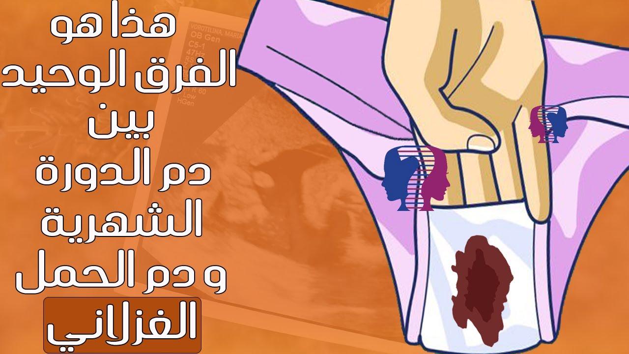 الأسباب الطبية وراء ظهور الحمل الغزلاني وتأثيرها على المرأة