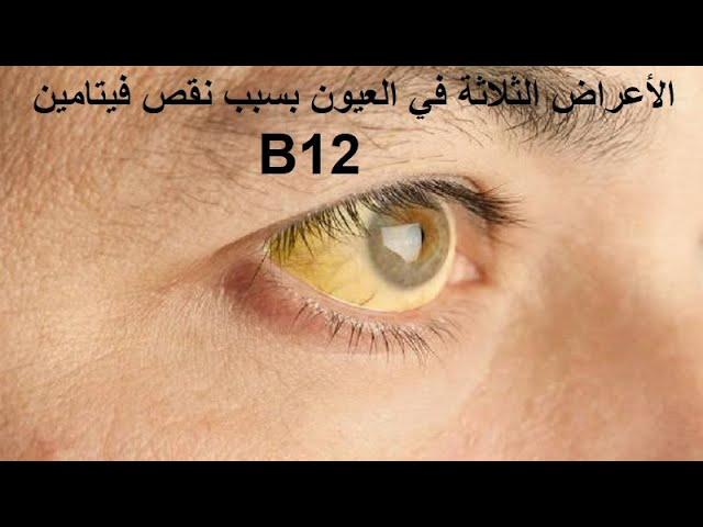 نصائح غذائية لتعويض نقص الفيتامينات وتحسين مظهر العين