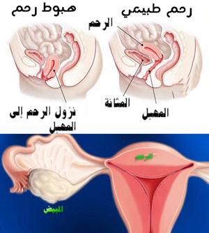 التغيرات الهرمونية وتأثيرها في حالات هبوط الرحم
